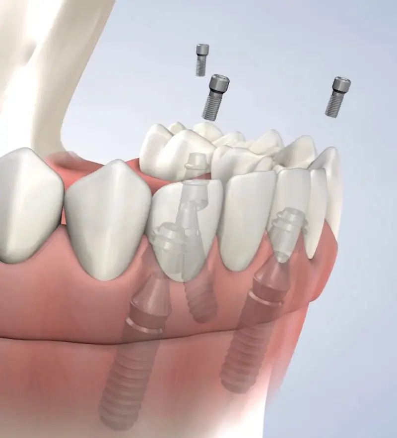 procedure-homepage-allon4-full-arch