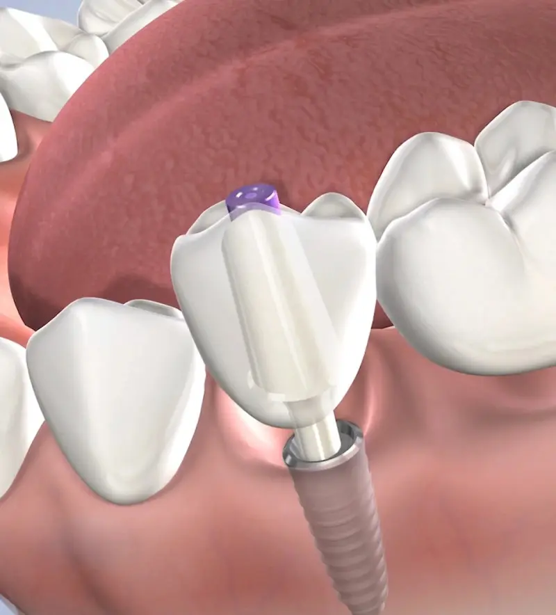 procedure-homepage-dental-implants