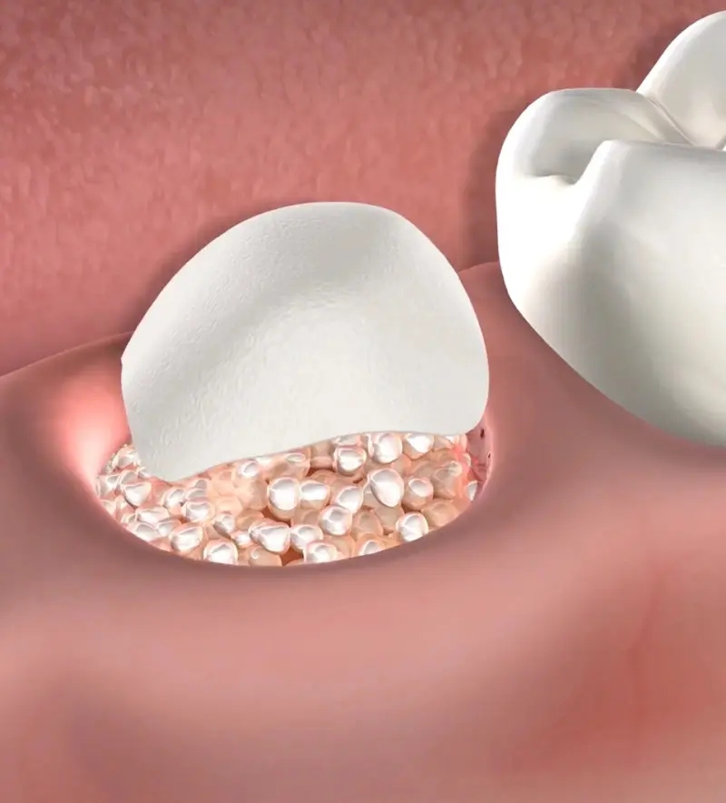 procedure-homepage-bone-grafting