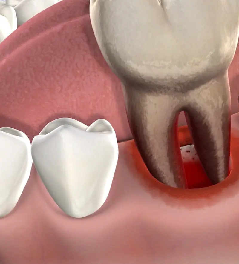 procedure-homepage-general-extractions