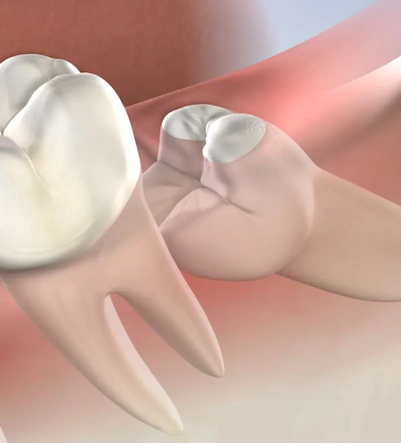 procedure-homepage-wisdon-teeth