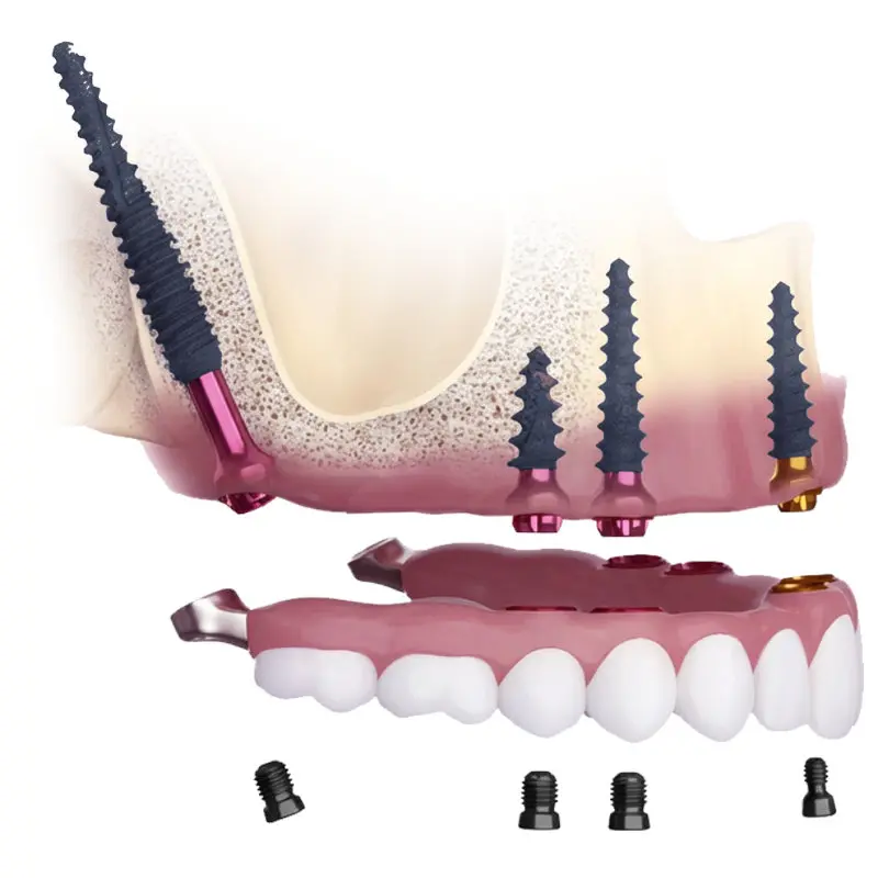 Zygomatic dental implants