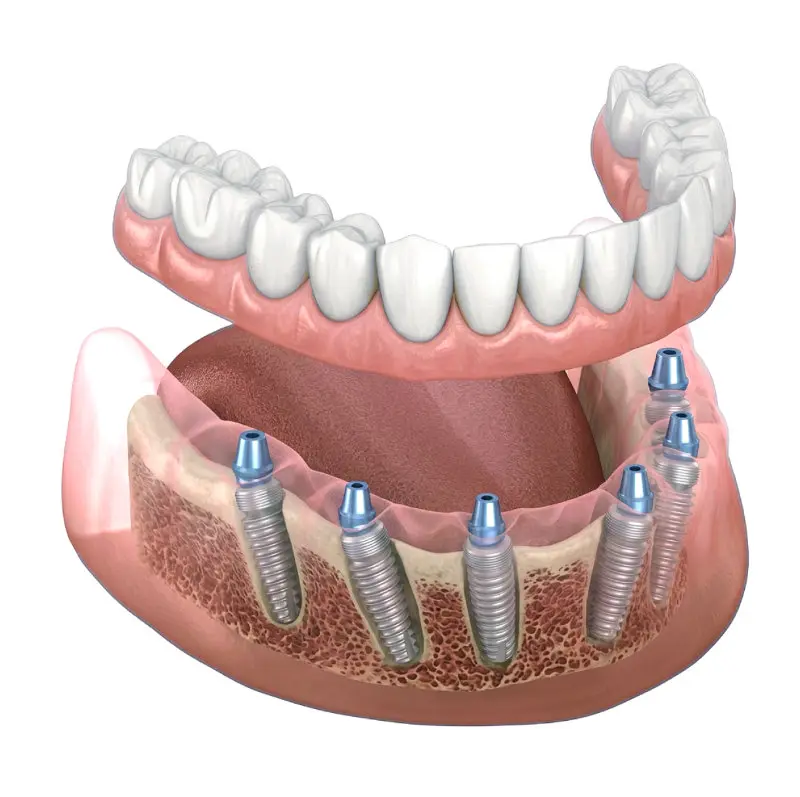 full arch dental implants