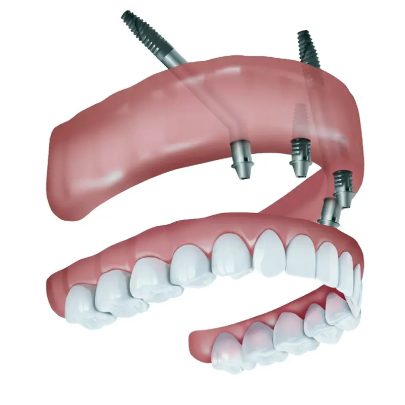 pterygoid dental implants