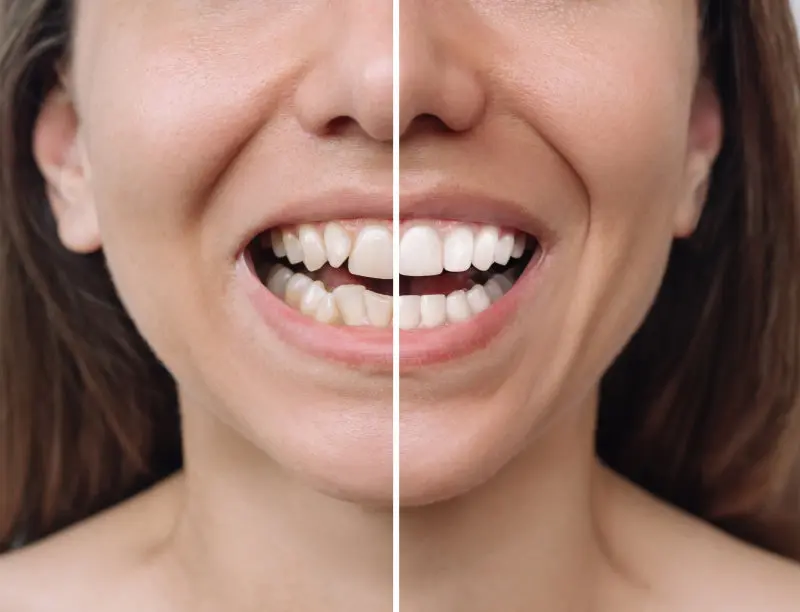 before and after smile transformation
