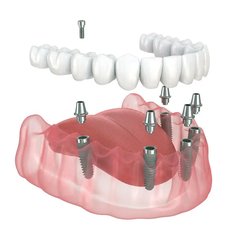All-on-X dental implants