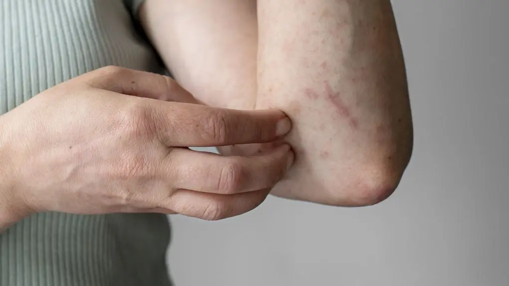 Augusta Acupuncture Clinic | Acupuncture for Eczema and Psoriasis in Augusta