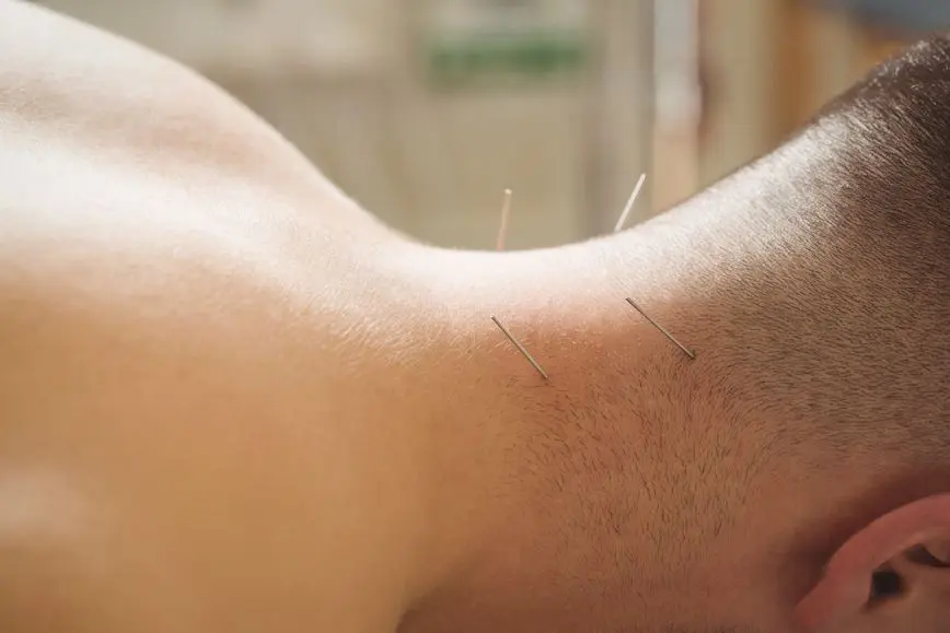 patient-getting-dry-needling-neck (1) Augusta Acupuncture Clinic | Top Neck Pain Doctor in Augusta