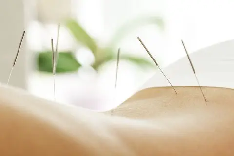 acupuncture services
