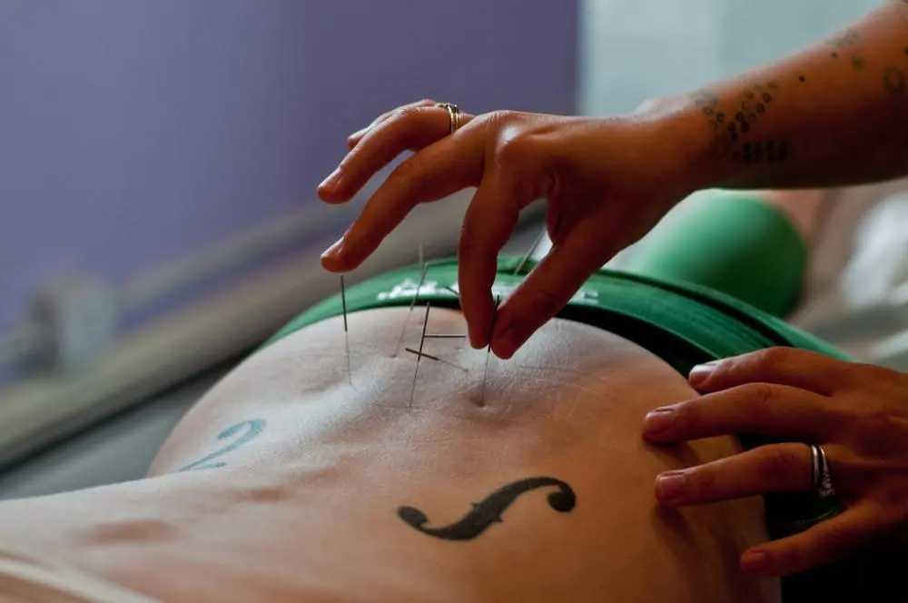 sherrell acupuncture
