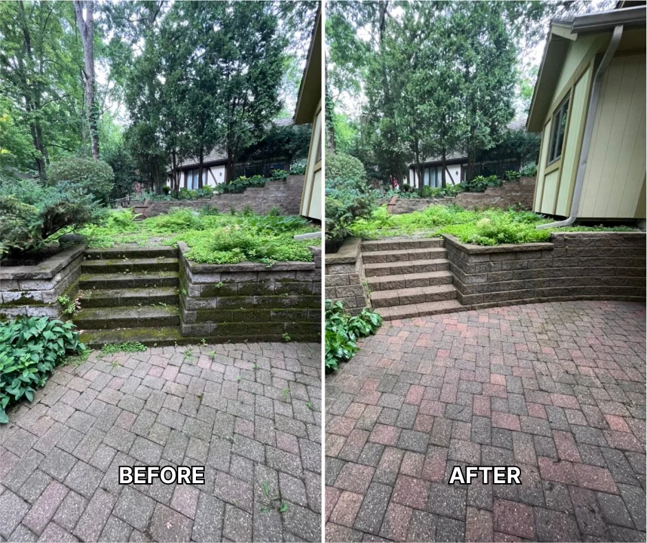 Gum Removal Minneapolis