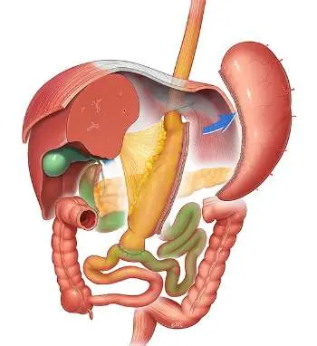 Illustration of SADI-S (single anastomosis duodeno-ileal bypass) procedure