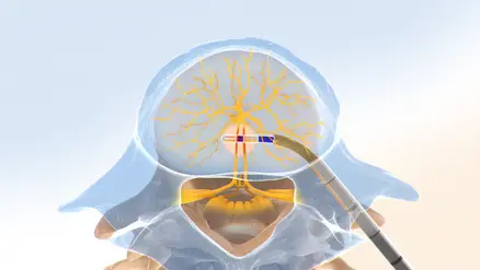 Intracept Procedure step 4 illustration showing basivertebral nerve ablation