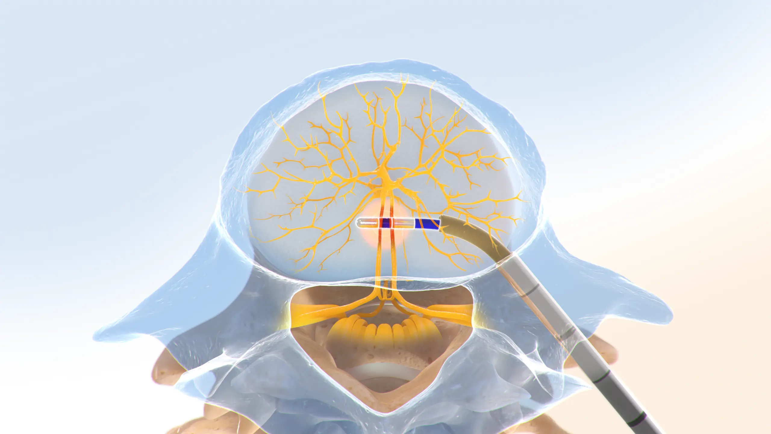 Intracept Procedure step 4 illustration showing basivertebral nerve ablation