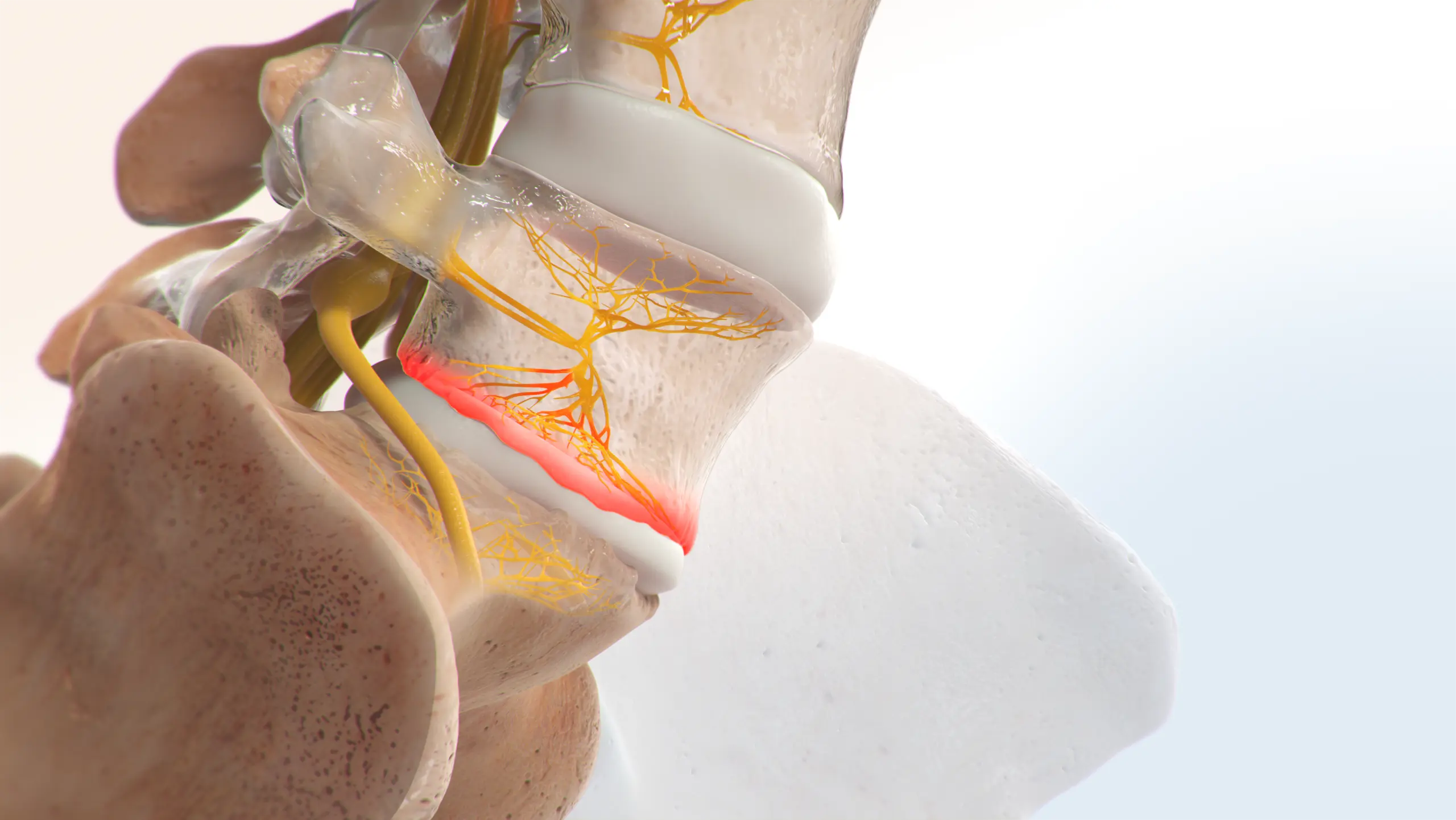 Illustration showing the basivertebral nerve carrying pain signals from the vertebral endplates