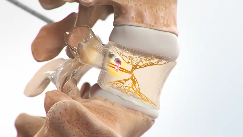 Intracept Procedure illustration showing basivertebral nerve ablation within the vertebral body