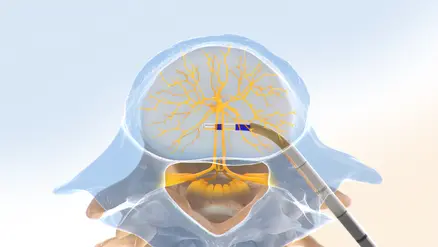 Intracept Procedure step 3 illustration