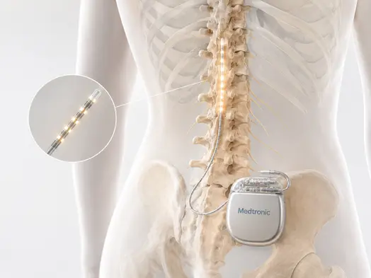 Spinal cord stimulation for chronic pain