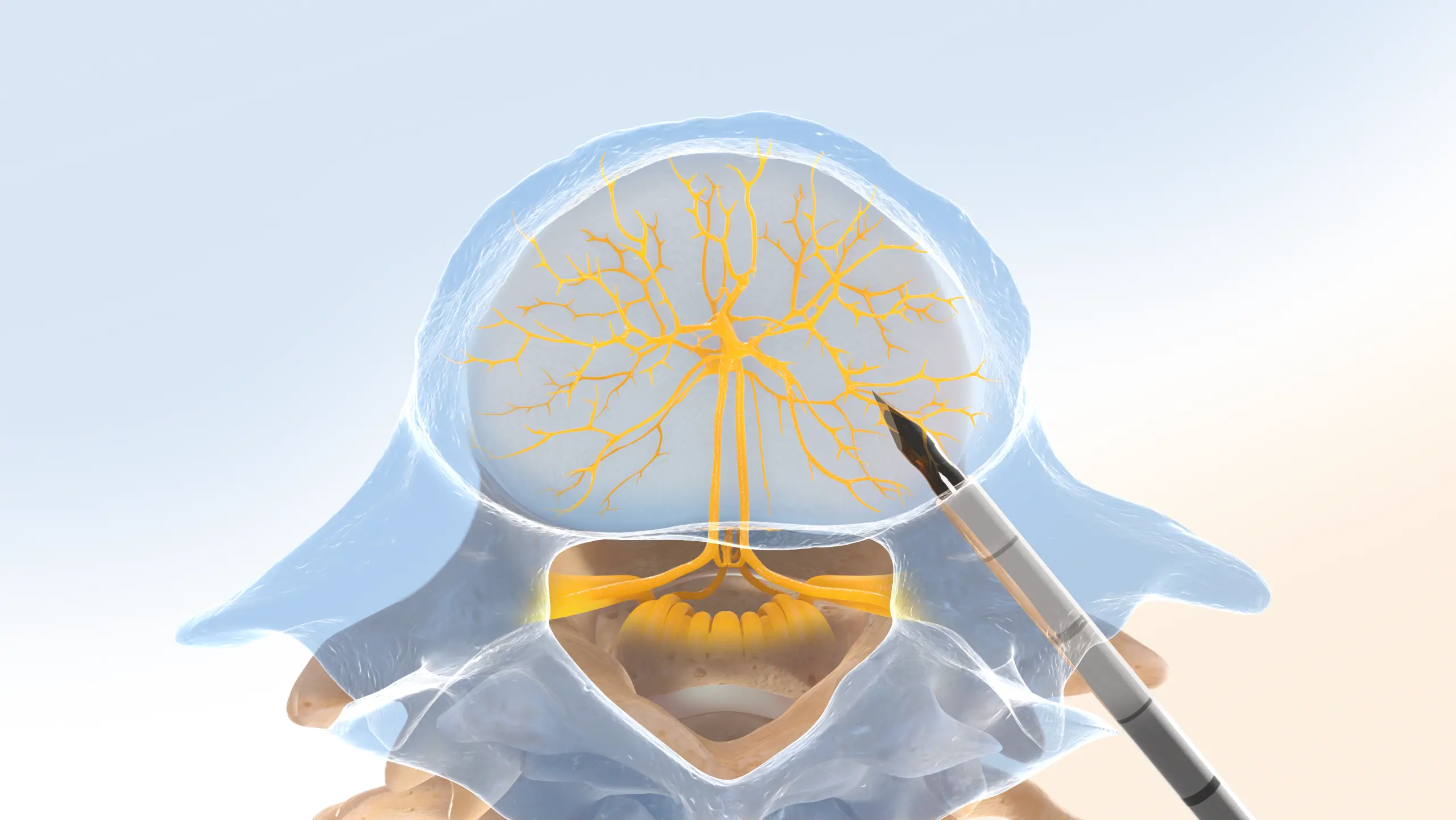 Intracept Procedure step 1 illustration