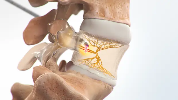 Intracept procedure for chronic low back pain