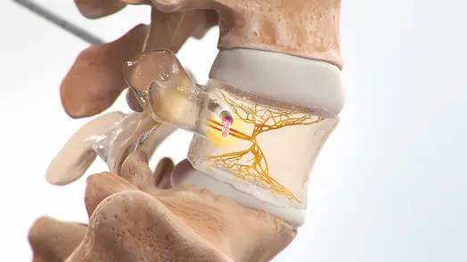 Intracept Procedure for vertebrogenic low back pain