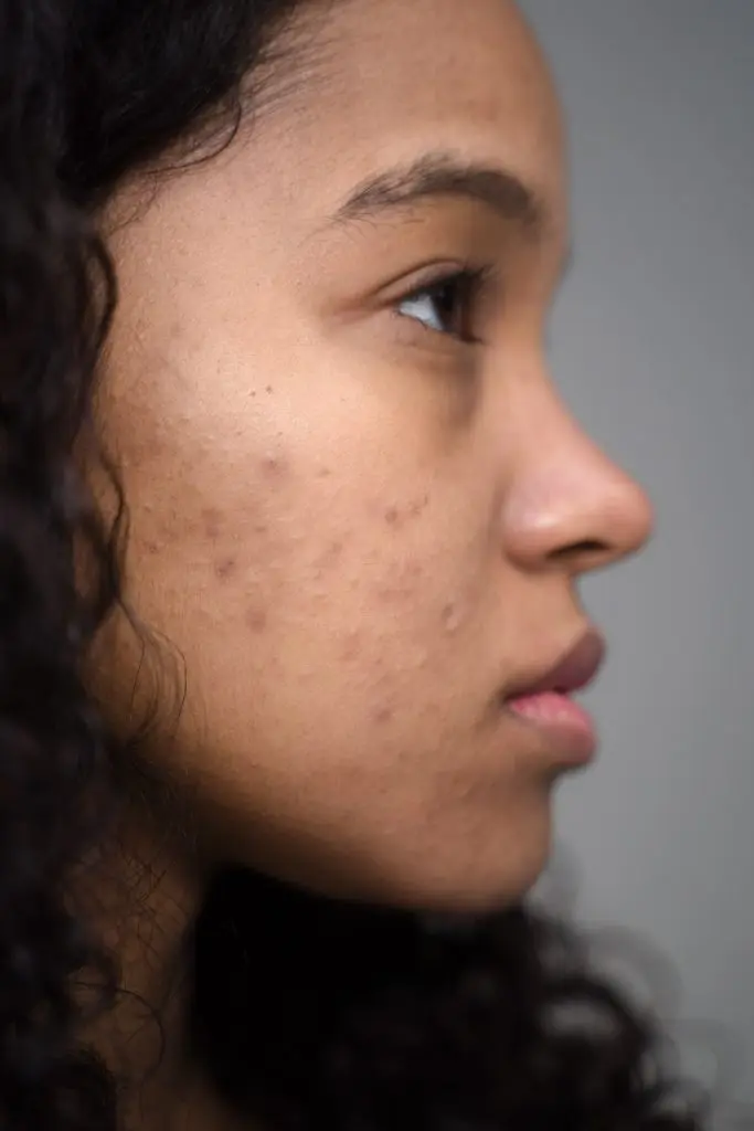 Finding Solutions for Acne by Wellness Minneapolis