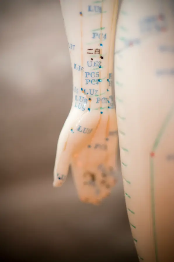 Acupuncture for Trigger Finger