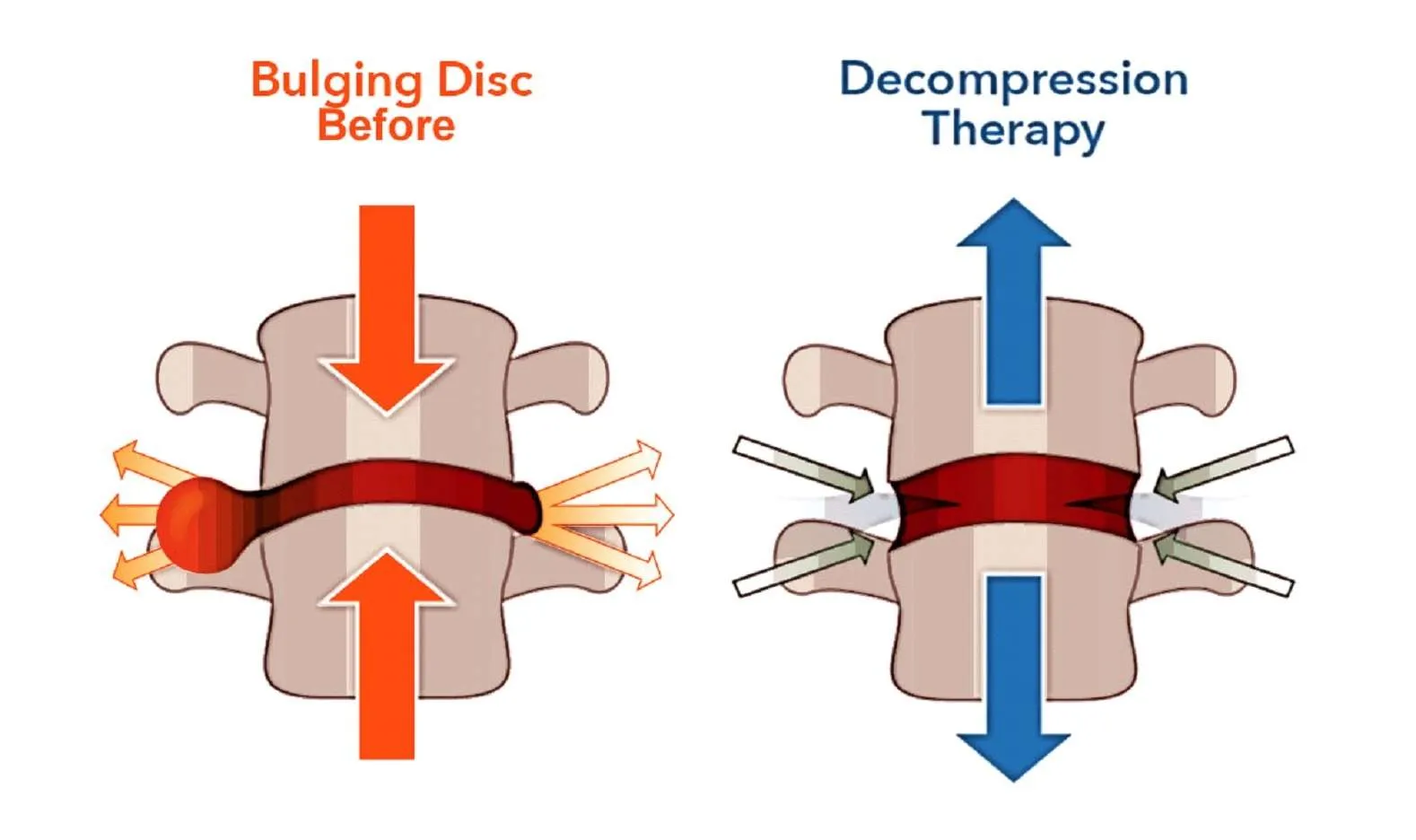 Bulging disc before and after decompression therapy.