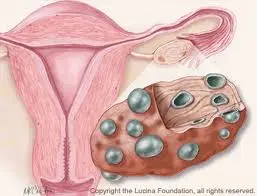 NCCRM Polycystic Ovarian Syndrome Diagram