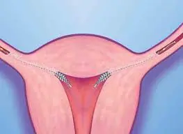 Essure - NCCRM
