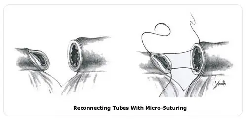 tubal_figure2 Micro-Suturing - NCCRM