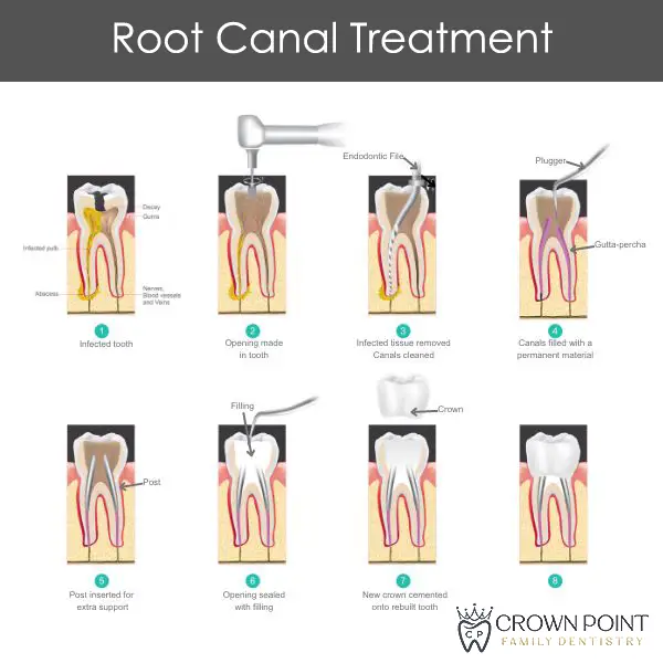 Diagram of the root canal process.