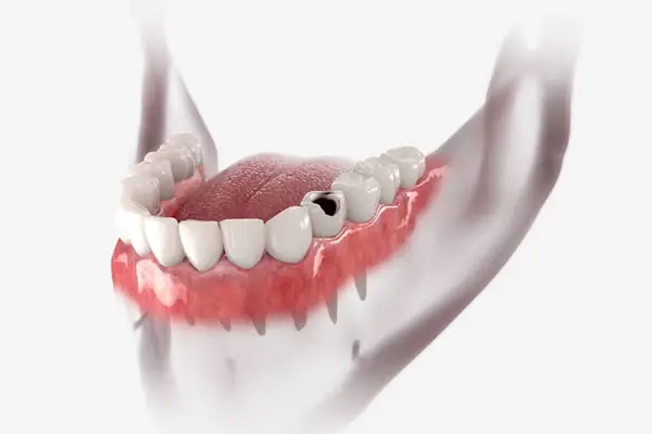 Dental crowns are recommended with teeth are decayed or fractured and can be restored with a crown, also called a cap.