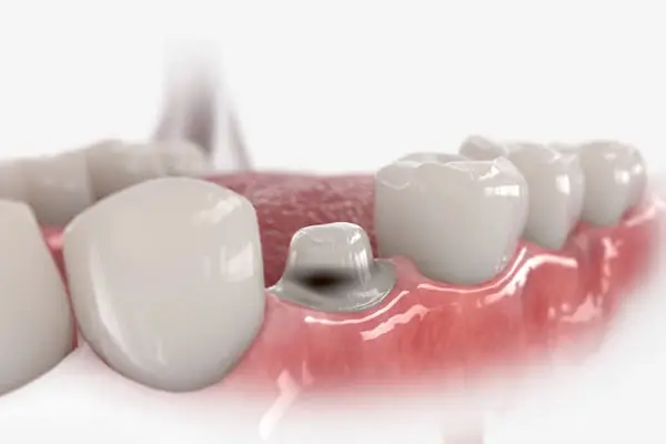 Expert dentals crowns at Crown Point Family Dentistry in Charlotte