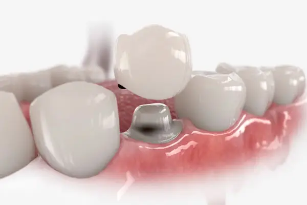 The process of making a dental crown, also called caps, by Crown Point Family Dentistry in Charlotte.