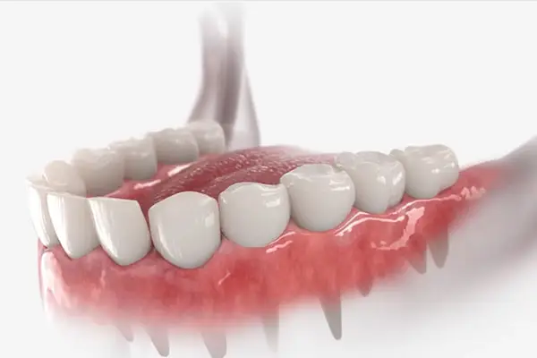 Dental crowns in Charlotte by Crown Point Family Dentistry can help restore decayed or fractured teeth.