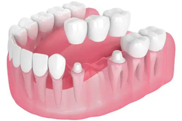 dental-bridge-charlotte-nc - Crown Point Family Dentistry Dental bridges are custom made and expertly placed for a perfect fit and aesthetic appearance.
