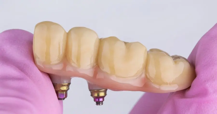 implant supported bridge used to replace several missing teeth. In this picture, 4 teeth are replaced by using 2 dental implants.