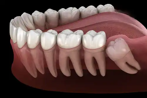 wisdom-teeth-removal - Crown Point Family Dentistry Gentle wisdom teeth removal in Charlotte, NC by Crown Point Family Dentistry