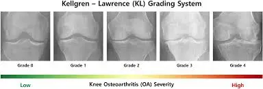 Kellgren-Lawrence scale for knee osteoarthritis grading