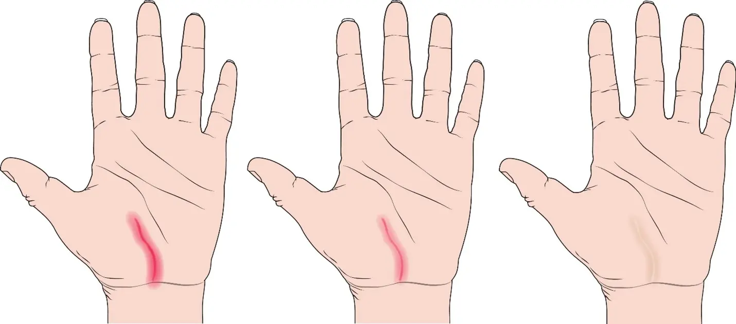 wound healing from stem cell treatment