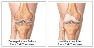 before-and-after-stem-cell-for-knee-pain