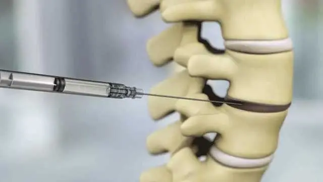 Injectable-discogenic-stem-cell-therapy