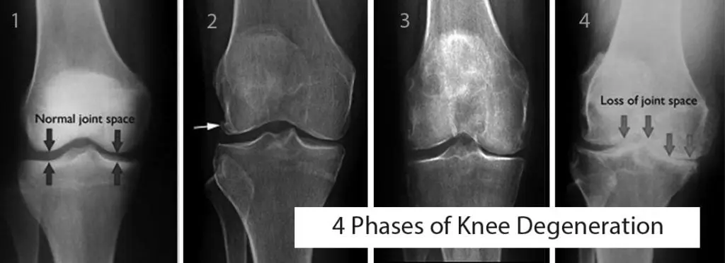 4-phases-of-knee-degeneration