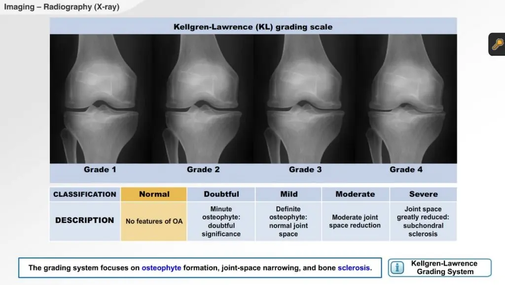 knee xray2