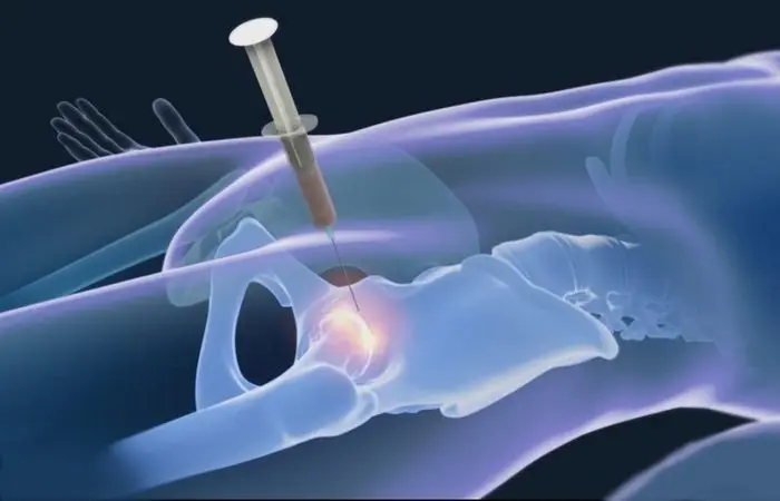 stem-cell-treatment-for-hip-osteoarthritis