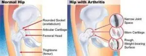 Is Joint Replacement Surgery the Best Option for Arthritis? 2 hip-pain