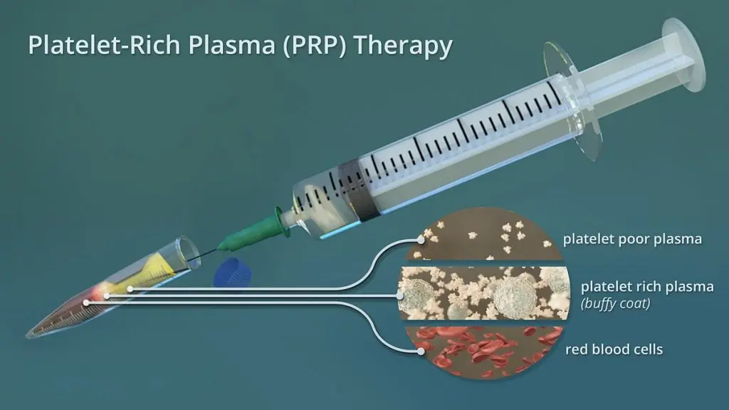 PRP for hip pain relief PRP-for-hip-pain