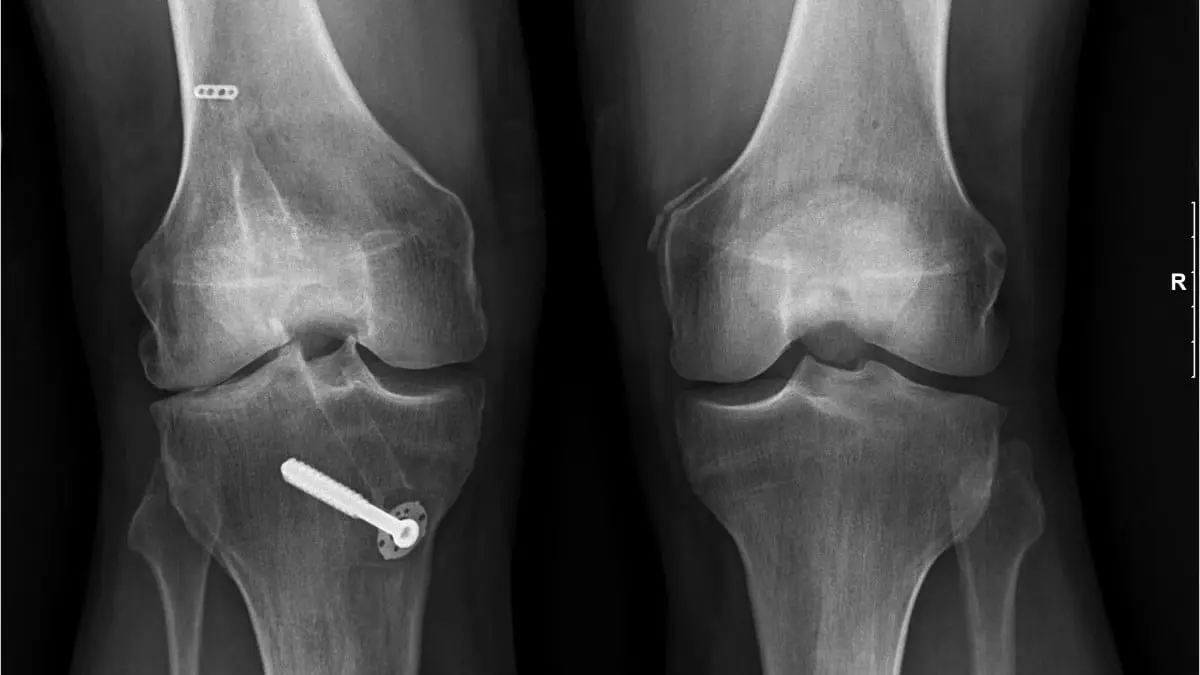Stem Cell Therapy for Knees