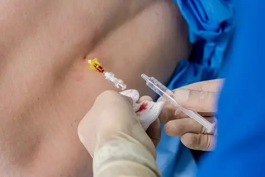 Stem cell treatment for lower back pain is cheaper than conventional back surgery. cost-of-stem-cell-therapy-for-back-pain